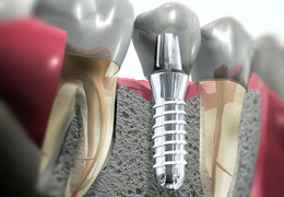 Имплантология в стоматологии Пульс во Фрязино